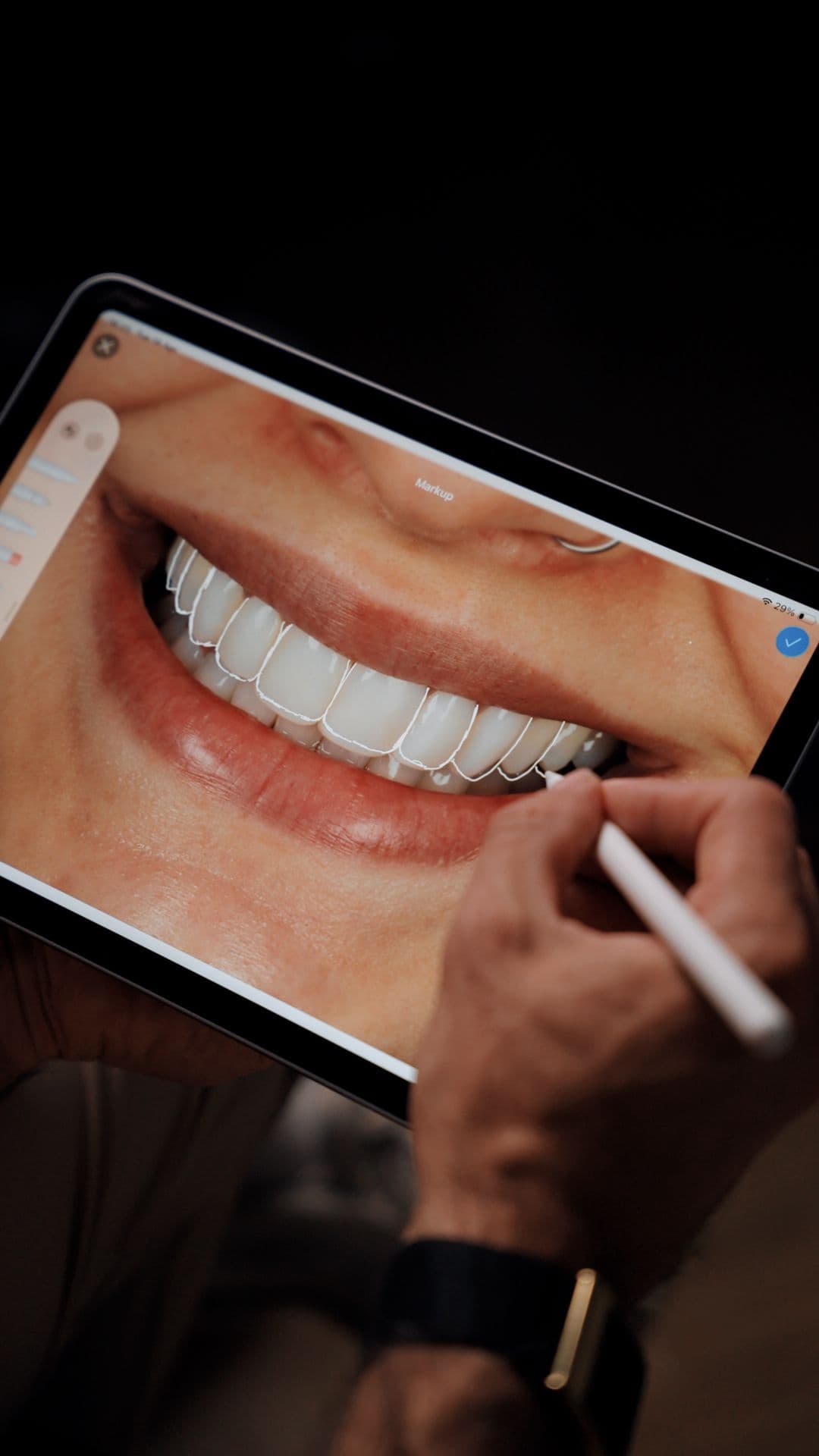 Smile transformation by Dr Phil 3