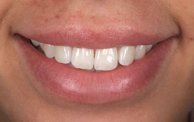 Composite Bonding