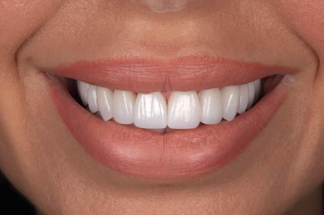 Veneers