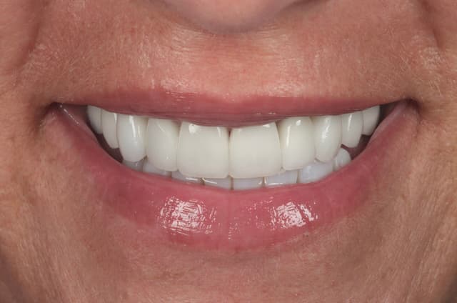 Porcelain Veneers