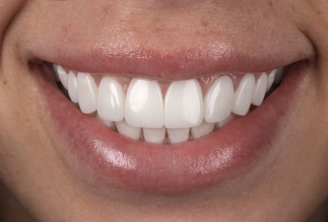 Composite Bonding