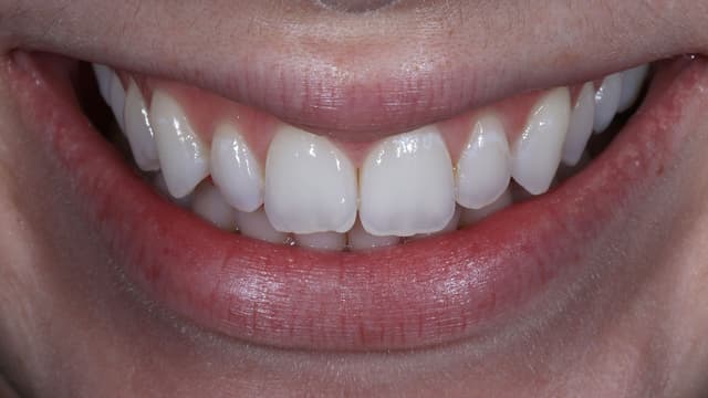 Teeth whitening