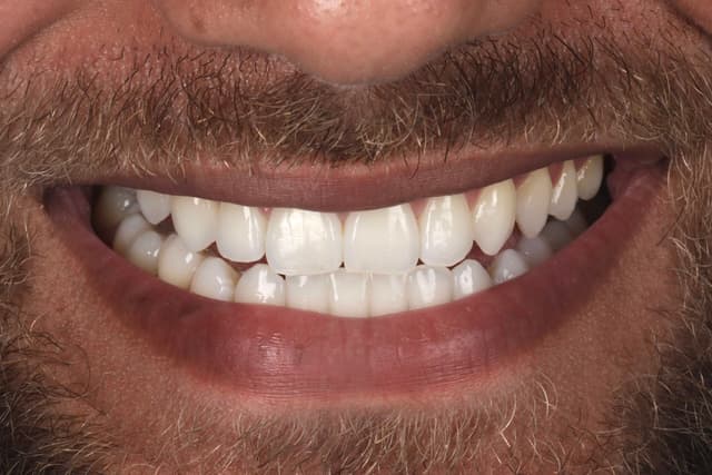 Teeth Whitening