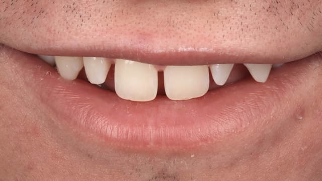 Composite Bonding