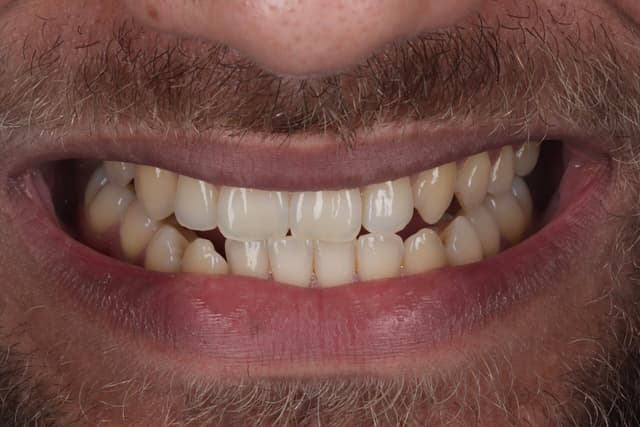 Teeth Whitening