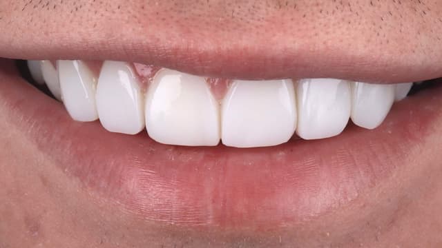 Composite Bonding